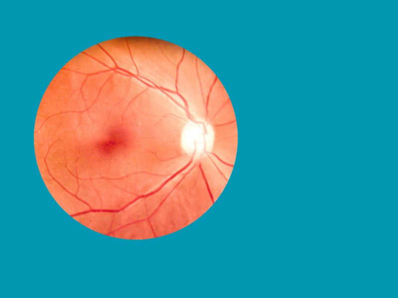 Maculopatia: comprendere la malattia che ruba la vista